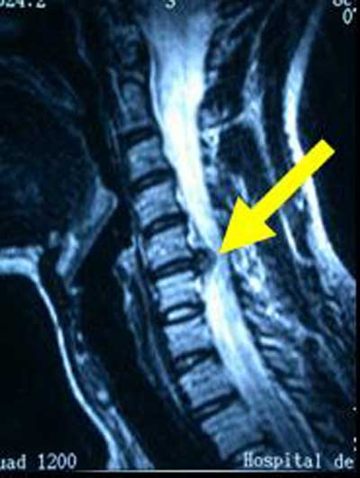 Centro especializado en columna explica mielopatía cervical